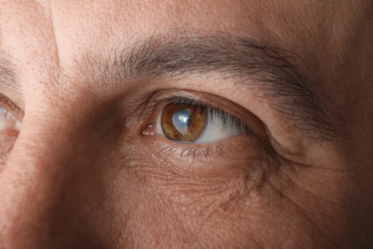How Long Does Cataract Surgery Take?