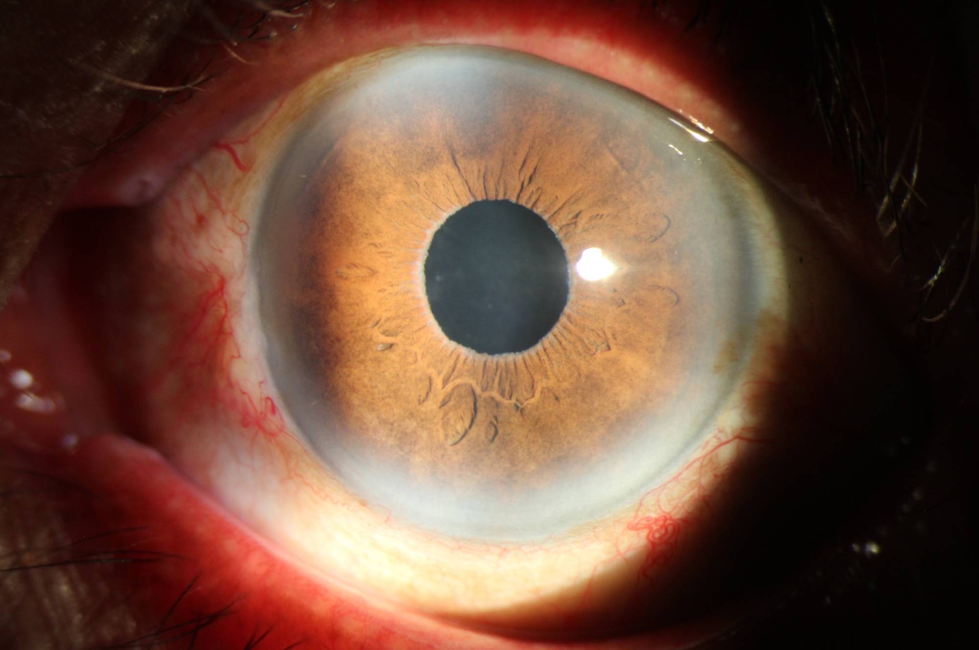 Slit lamp photograph of an intraocular lens implant following cataract surgery, with whitish debris along the pupillary margin
